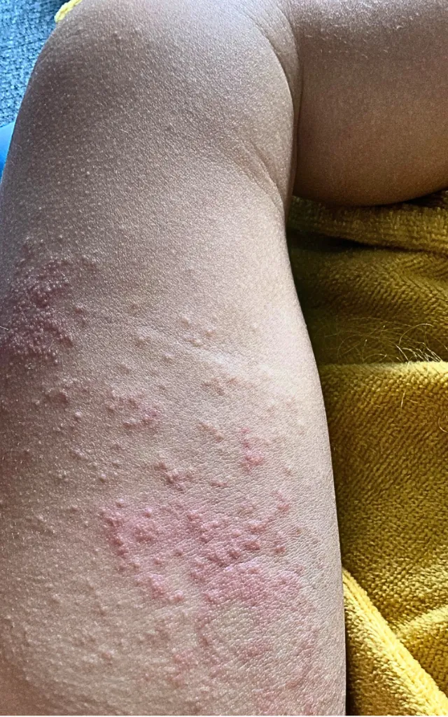 Before: Eczema – 3 weeks