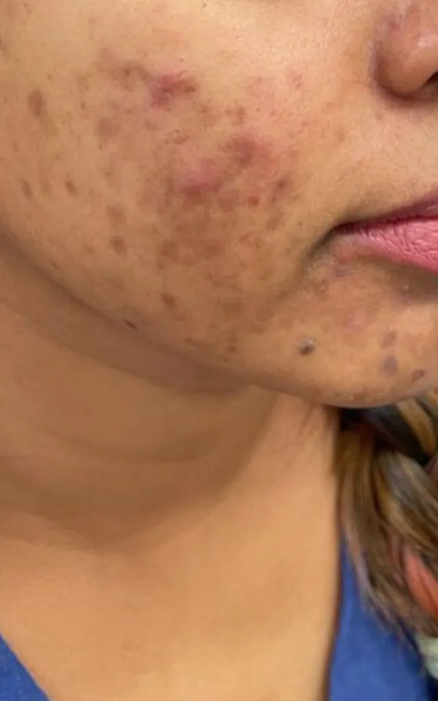 After: Acne – 8 weeks