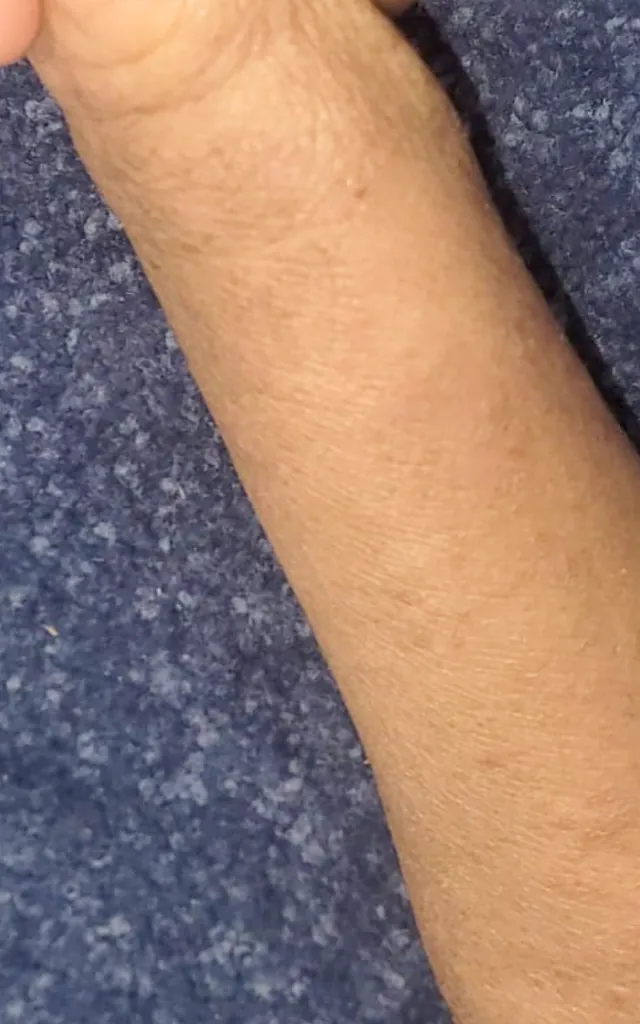 After: Eczema – 4 weeks