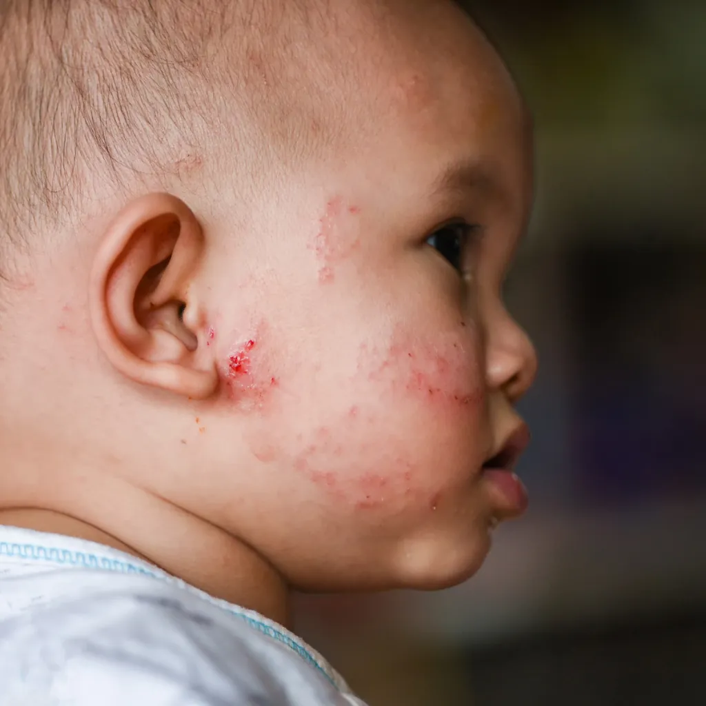 Eczema