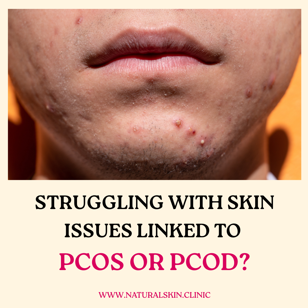 🌿 Struggling with Skin Issues Linked to PCOS or PCOD? You're Not Alone — And There Are Natural Ways to Support Your Skin Health.